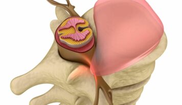 Medicina regenerativa en hernia discal: detrás de la curación mediante la respuesta inmunológica