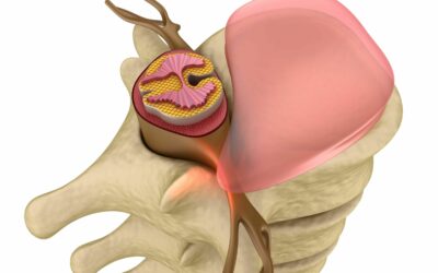 Medicina regenerativa en hernia discal: detrás de la curación mediante la respuesta inmunológica