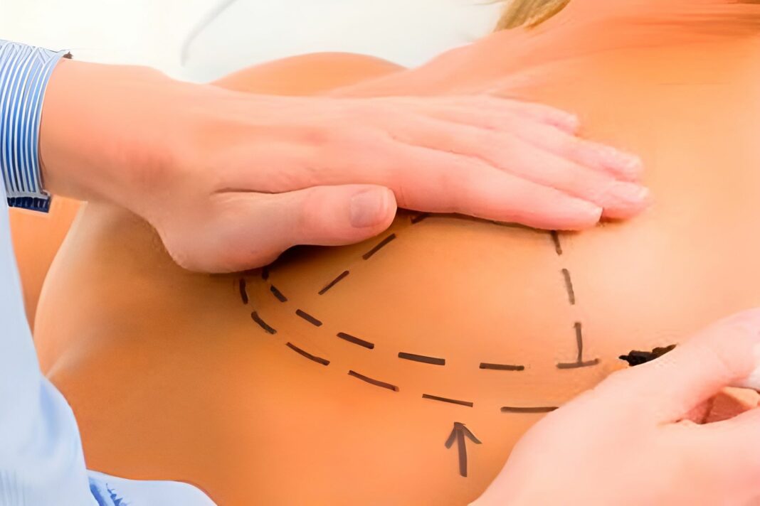 Estética Castro Sierra da las claves por las que el aumento de pecho sigue siendo la operación estética más realizada en España