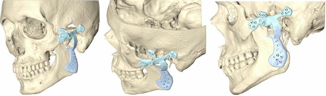 La reconstrucción de la articulación temporomandibular por un tumor requiere diseñar una prótesis a medida
