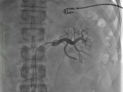 Dr. José Ramón Rumoroso: «La denervación renal es una alternativa para pacientes con hipertensión no controlada»