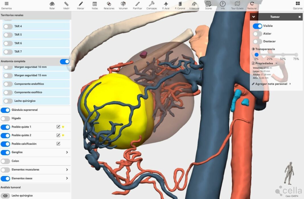 La planificación 3D reduce el tiempo de las cirugías y el riesgo de infecciones urinarias en extirpaciones parciales de riñón, según expertos del curso de cáncer renal